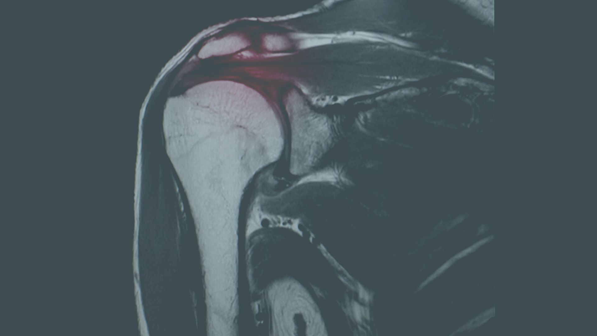 What Happens if You Leave a Rotator Cuff Tear Untreated?