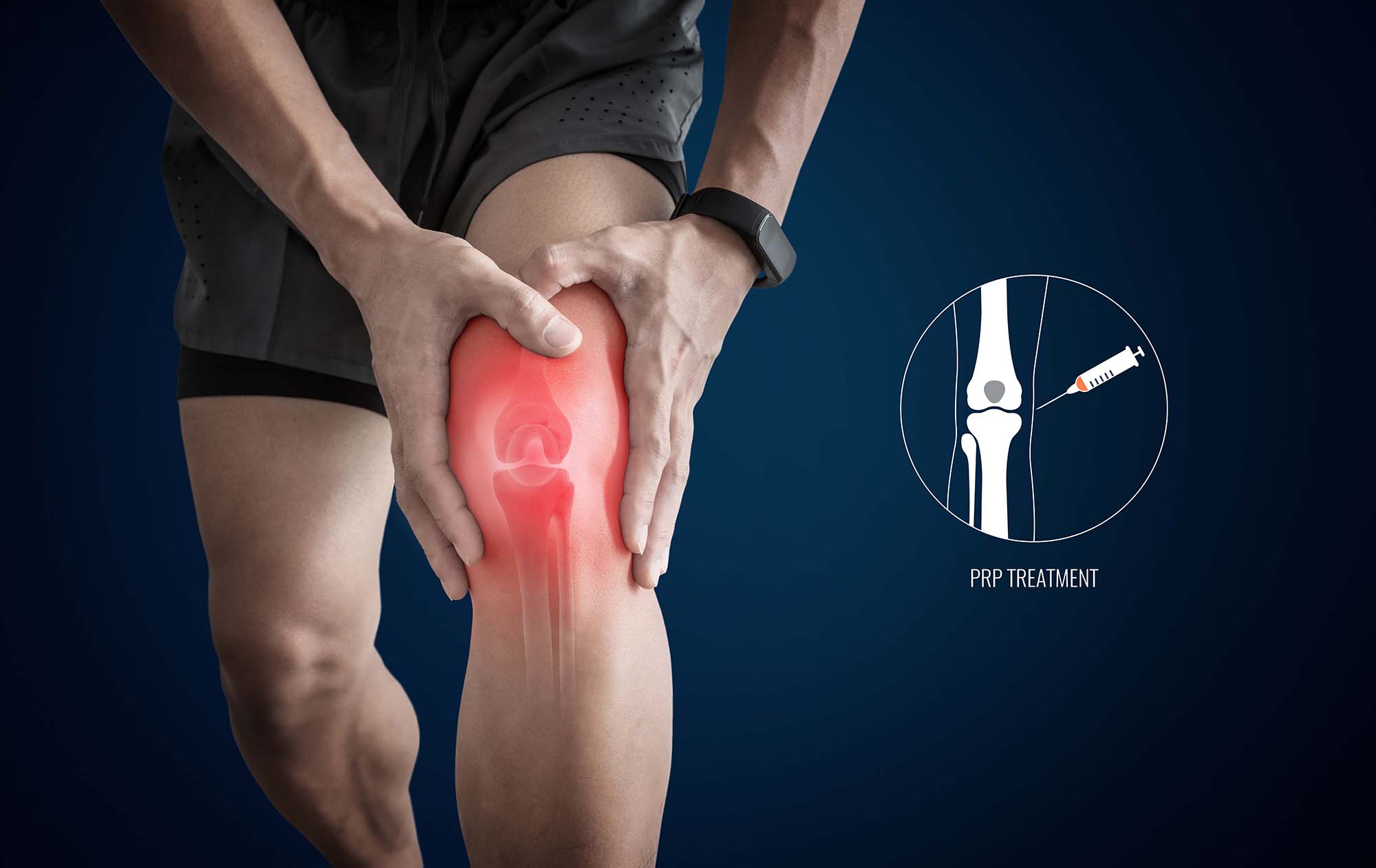 Platelet Rich Plasma (PRP) Therapy for the Knee