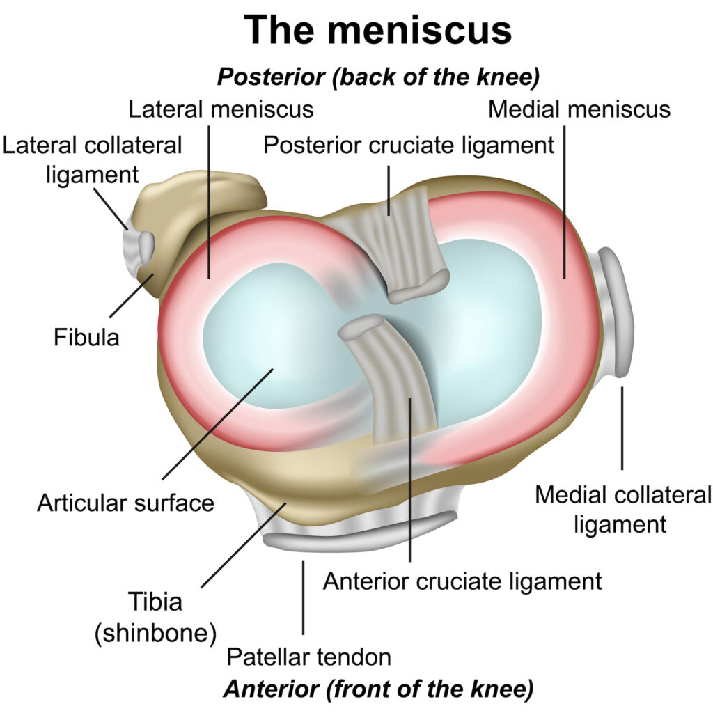 meniscus tears santa barbara ca