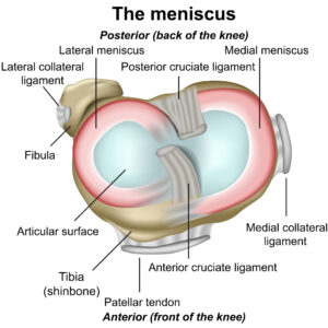 meniscus tear santa barbara