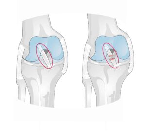 Torn ACL Illustration
