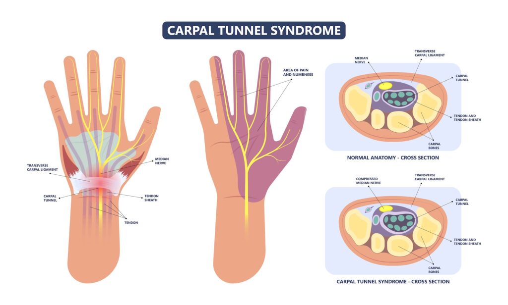 carpal tunnel syndrome treatment santa barbara