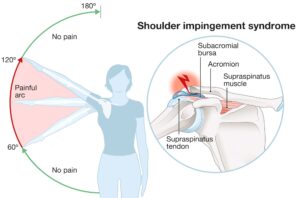 symptoms of shoulder impingement syndrome