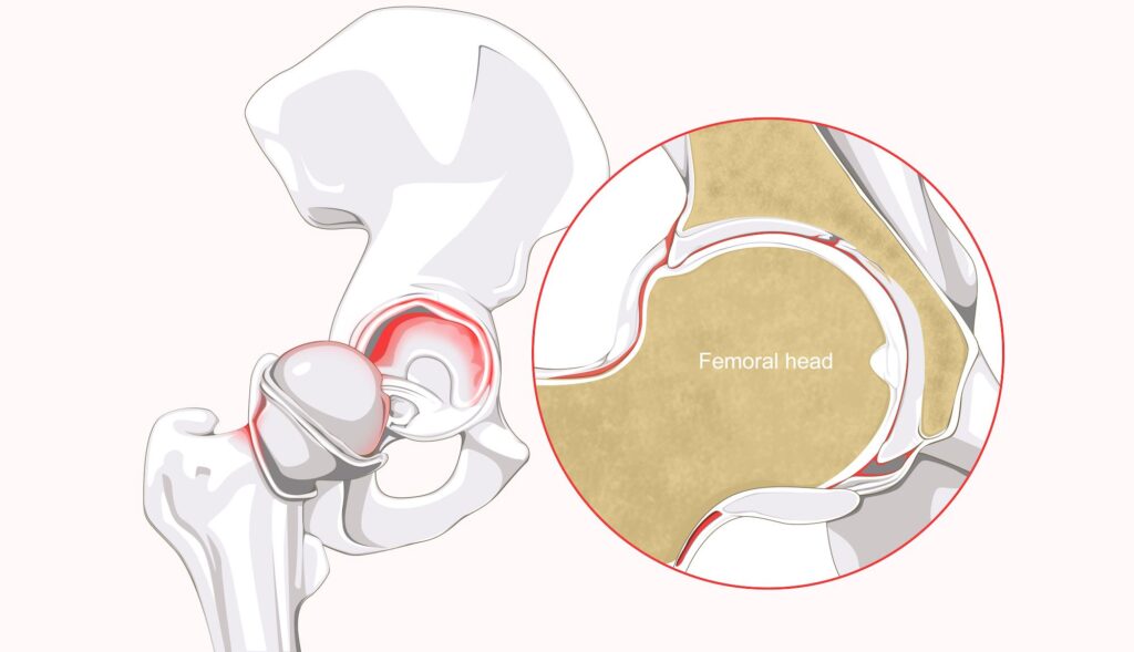 hip preservation surgery for Labral Tears