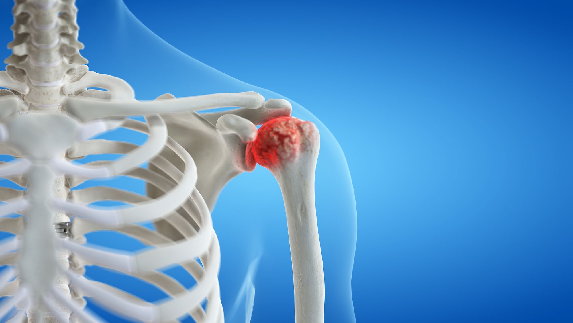 Shoulder Arthritis: What Is It, Symptoms, Treatment, and Prevention