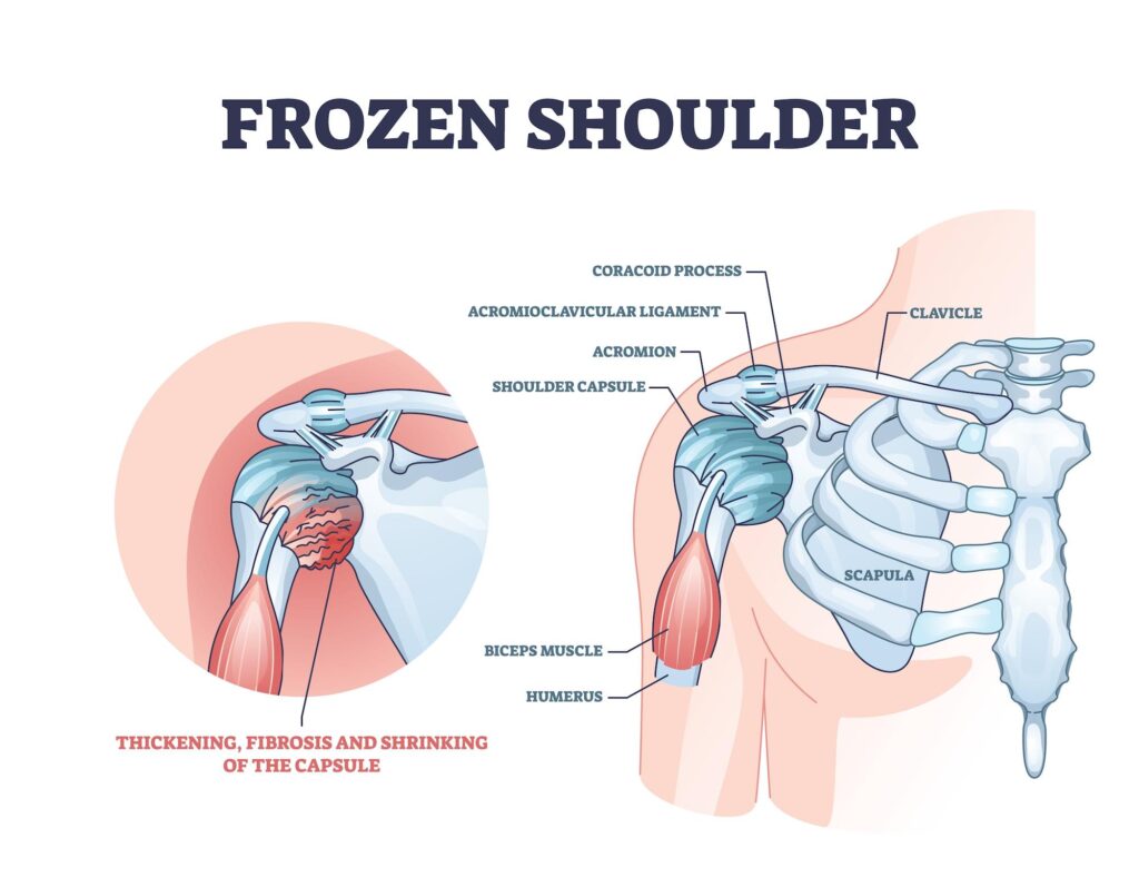 Diagram of a frozen shoulder