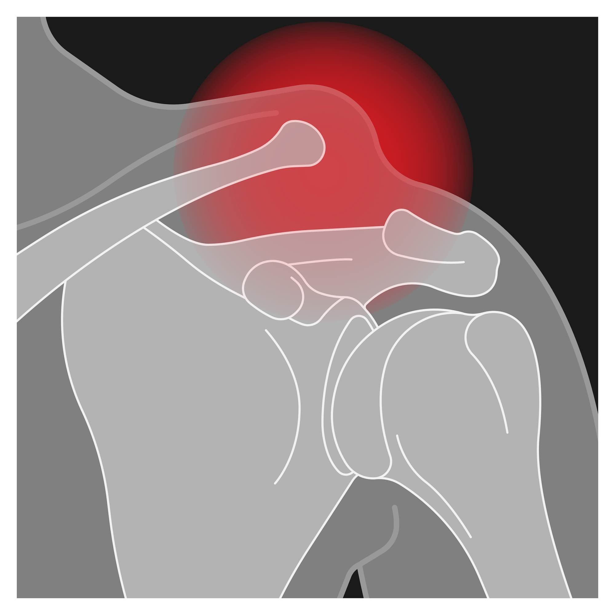 The (Acromio-Clavicular) AC Joint: Common Conditions and Treatment Options