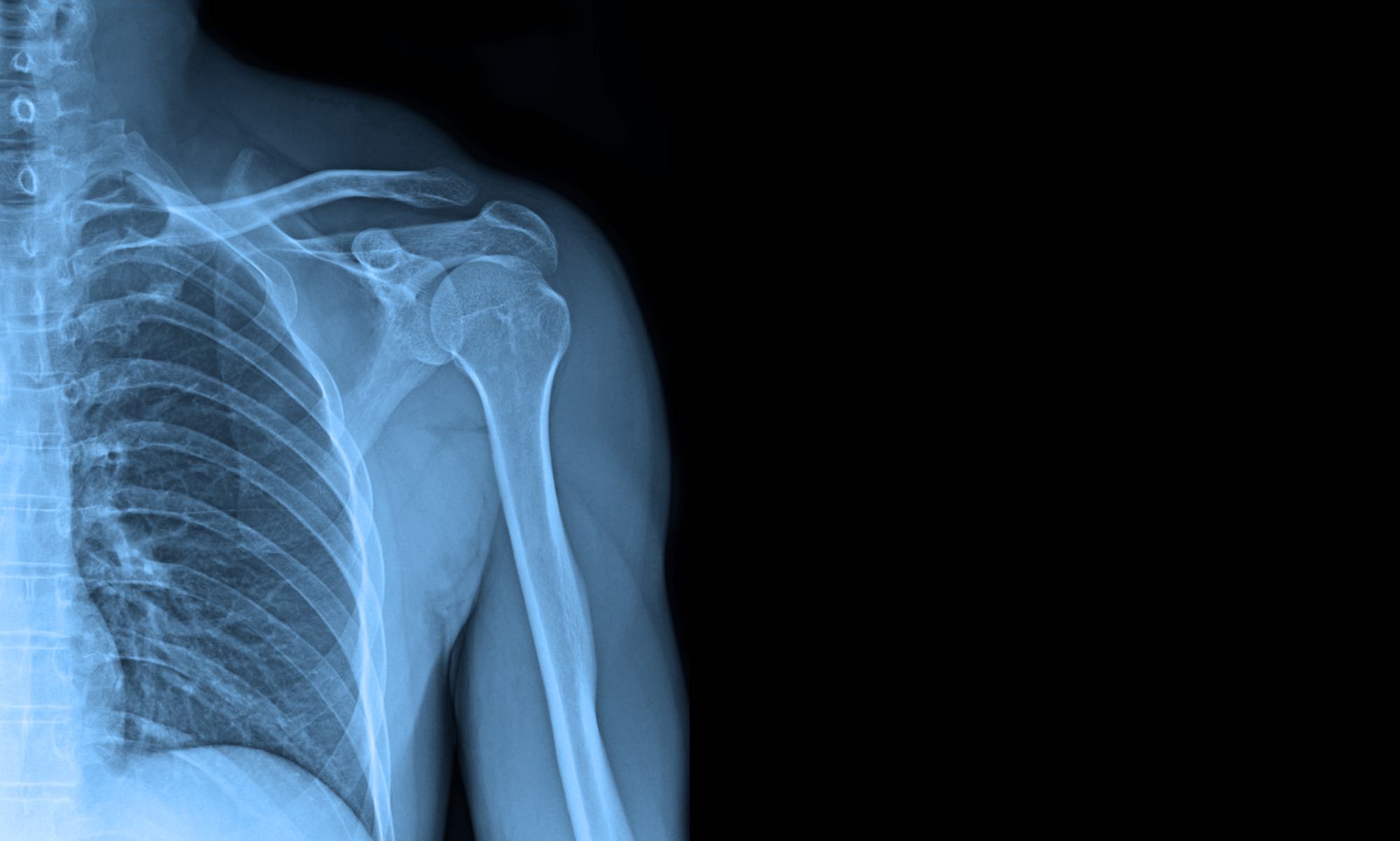 Can an X-Ray Show a Torn Rotator Cuff?