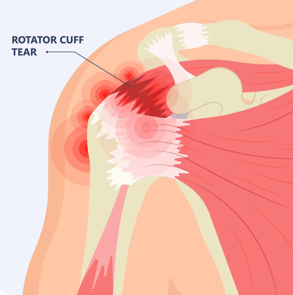 Diagram of a rotator cuff tear